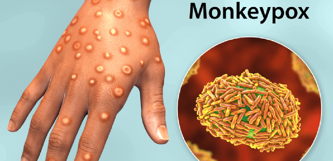 Monkeypox_disease