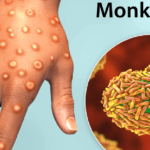 Monkeypox_disease