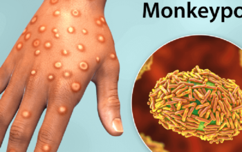 Monkeypox_disease