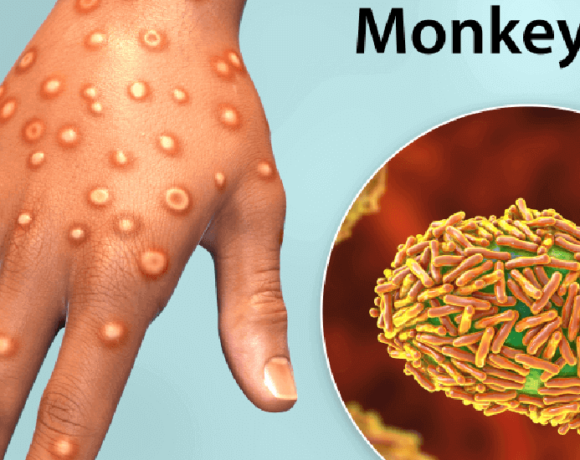 Monkeypox_disease